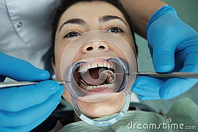 Close up of patient with cheek retractor in mouth receiving dental treatment Stock Photo