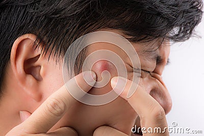 Close up photo of acne prone skin, a man squeezing his pimple Stock Photo