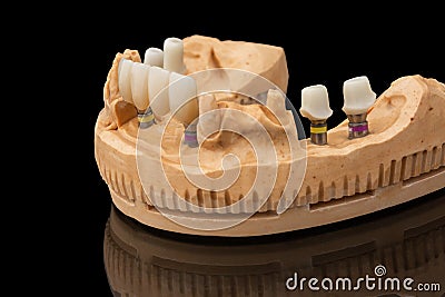 Close-up photo of a dental lower jaw prosthesis on black glass background. Artificial jaw with veneers and crowns. Tooth Stock Photo