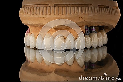 Close-up photo of a dental upper jaw prosthesis on black glass background. Artificial jaw with veneers and crowns. Tooth Stock Photo