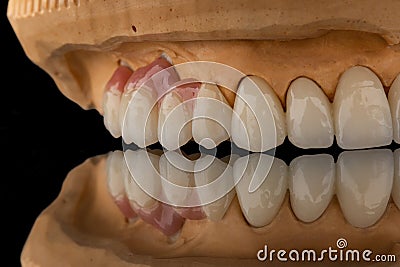 Close-up photo of a dental upper jaw prosthesis on black glass background. Artificial jaw with veneers and crowns. Tooth Stock Photo