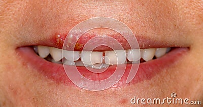 Oral herpes simplex virus infection Stock Photo