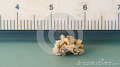 KIDNEY STONE 9mm Stock Photo