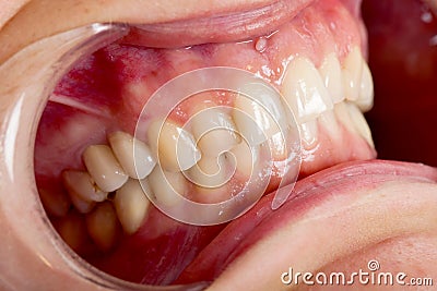 Cheek retractor close up Stock Photo