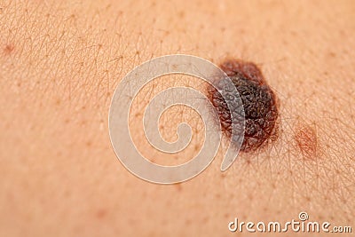 Dangerous nevus on skin - melanoma Stock Photo