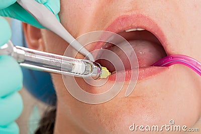 Dental anesthesia Stock Photo