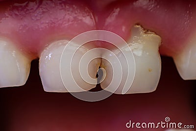 close-up picture of an incisor tooth that is about to erupt in a 7-year-old child Stock Photo