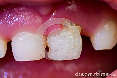 close-up picture of an incisor tooth that is about to erupt in a 7-year-old child Stock Photo