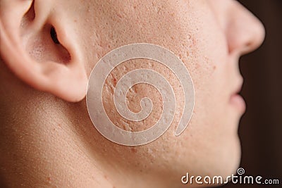 Acne scars on the face Stock Photo