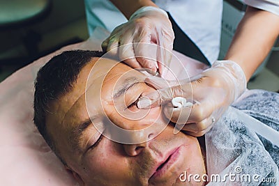 Close-up of procedure for face lifting PDO Suture operation, face lifting surgery. innovative technique of New thread Stock Photo