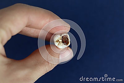 Close up of a removed sore tooth. Toothache. Stock Photo