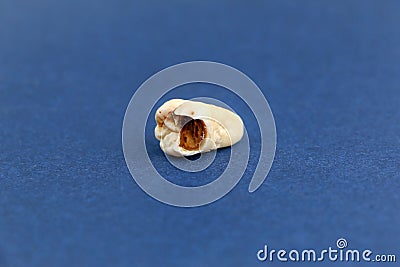 Close up of a removed sore tooth. Toothache. Stock Photo