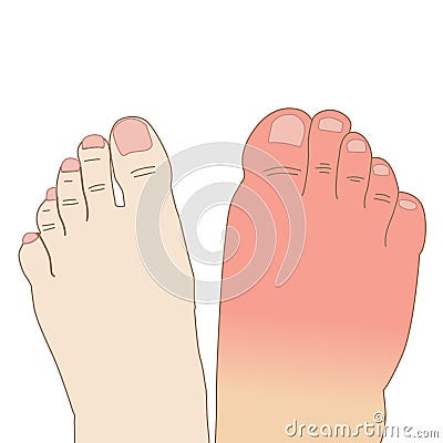 Right-foot swollen infection sting allergy injury in comparison to the normal left foot, illustration on white background Cartoon Illustration