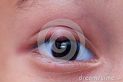 Close up right upper eye lid abscess Stock Photo