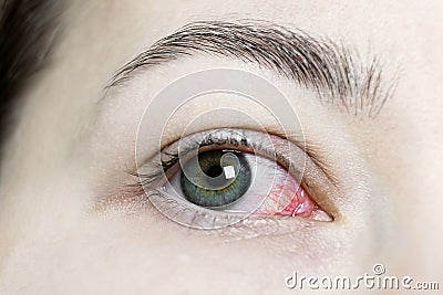 Close up of a severe bloodshot red eye. Viral Blepharitis, Conjunctivitis, Adenoviruses. Irritated or infected eye. Stock Photo