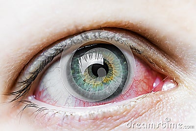 Close up of a severe bloodshot red eye. Viral Blepharitis, Conjunctivitis, Adenoviruses. Irritated or infected eye. Stock Photo