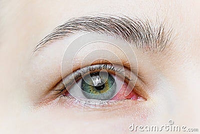 Close up of a severe bloodshot red eye. Viral Blepharitis, Conjunctivitis, Adenoviruses. Irritated or infected eye. Stock Photo