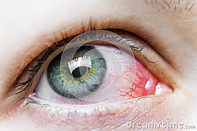 Close up of a severe bloodshot red eye. Viral Blepharitis, Conjunctivitis, Adenoviruses. Irritated or infected eye. Stock Photo