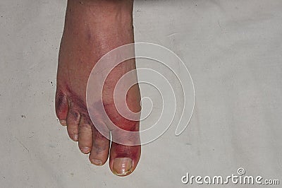 a human foot showing injured toes on light background Stock Photo