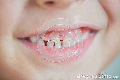 Close up shot of baby teeth with caries Stock Photo