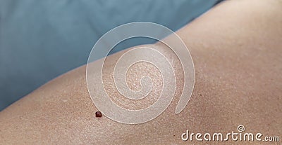 Brown Raised Skin Mole Stock Photo