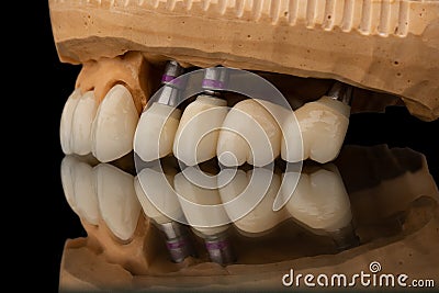 Close-up side view of a dental upper jaw prosthesis on black glass background. Artificial jaw with veneers and crowns Stock Photo