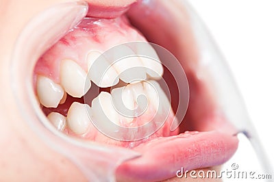 Close-up of side view of female patient cavity and teeth Stock Photo