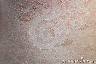 Close up skin disease Tinea versicolor/Pityriasis versicolor Stock Photo