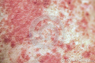 Allergic rash on the body close Stock Photo