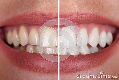 Woman`s Teeth Before And After Whitening Stock Photo