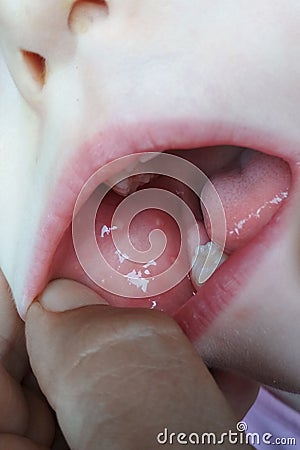 Close-up of stomatitis into mouth.Stomatitis viral genesis on the cheek of a child Stock Photo