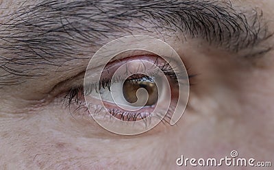 Close up, STYE, HORDEOLUM, CHALAZION, macro detail of an eye infection. Stock Photo