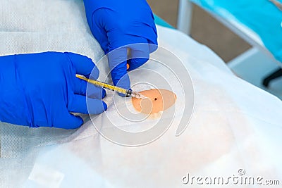 Close-up surgeon burns a mole on the back of the patient. Mole Removal Surgery Procedure Stock Photo