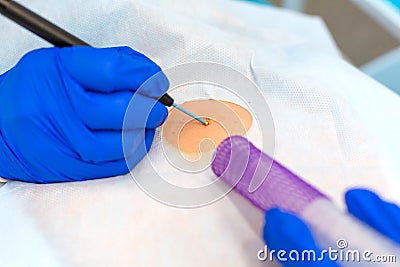 Close-up surgeon burns a mole on the back of the patient. Mole Removal Surgery Procedure Stock Photo