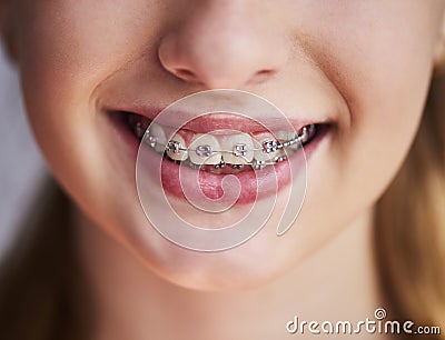 Close up of teeth with braces Stock Photo