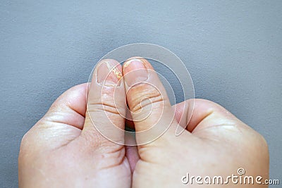 Close-up of thumb with fungus on a gray background. Onycholysis: detachment of the nail from the nail bed Stock Photo