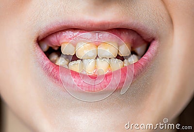 Close up of unhealthy baby teeths. Open mouth of a little boy with improperly growing teeth close-up. The concept of Stock Photo