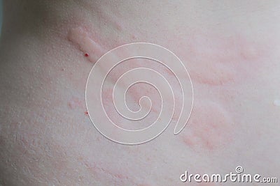 Close up of urticaria. Stock Photo