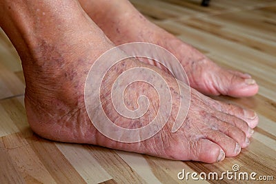 Close up varicose veins on the legs and feet Stock Photo