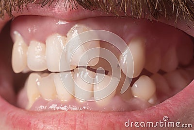 Close-up of very crooked teeth in an adult bearded guy. Not the right bite. Not healthy teeth. Violation of the position of the Stock Photo