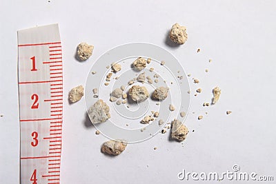 Flat lay or top view very small kidney stones with ruler at white background Stock Photo