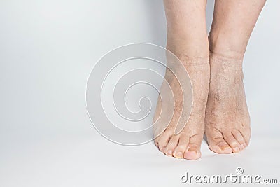 Close-up female sore skin of feet, dry heels isolated on a white background Stock Photo