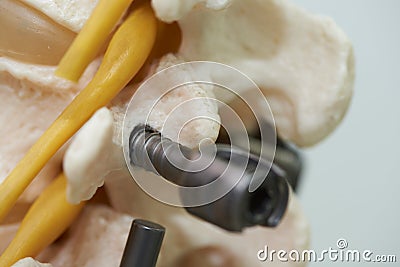 Close-up view of lumbar spine model and instrument fixation Stock Photo