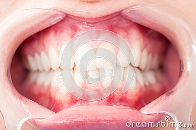 Close up of woman cavity protected by retractor Stock Photo