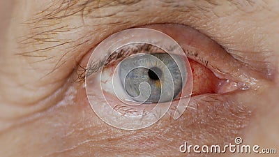 Close up. woman eye with burst capillaries, cataract surgery Stock Photo