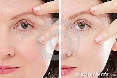 Close up woman face before after lifting injection. Middle age lady before-after wrinkled skin, eye bags, nasolabial folds. Face Stock Photo