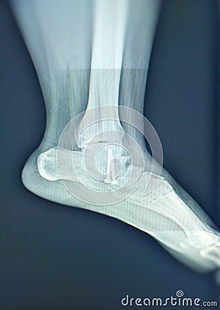 Close up X-ray foot post operation screws.Medical concept. Stock Photo