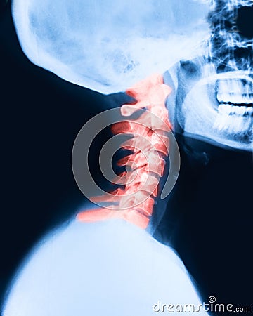 Xray of the cervical spine painful Stock Photo