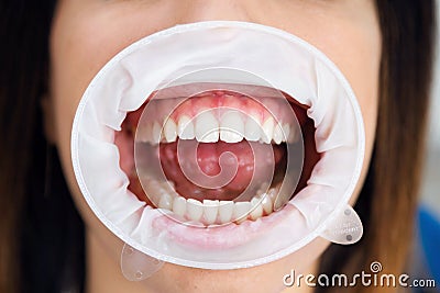 Young woman wearing mouth retractor waiting for oral examination in dentistry office Stock Photo
