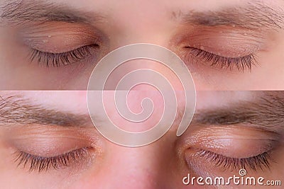 Man eyes before and after laser removal of papillomas on eyelids skin growths. Stock Photo